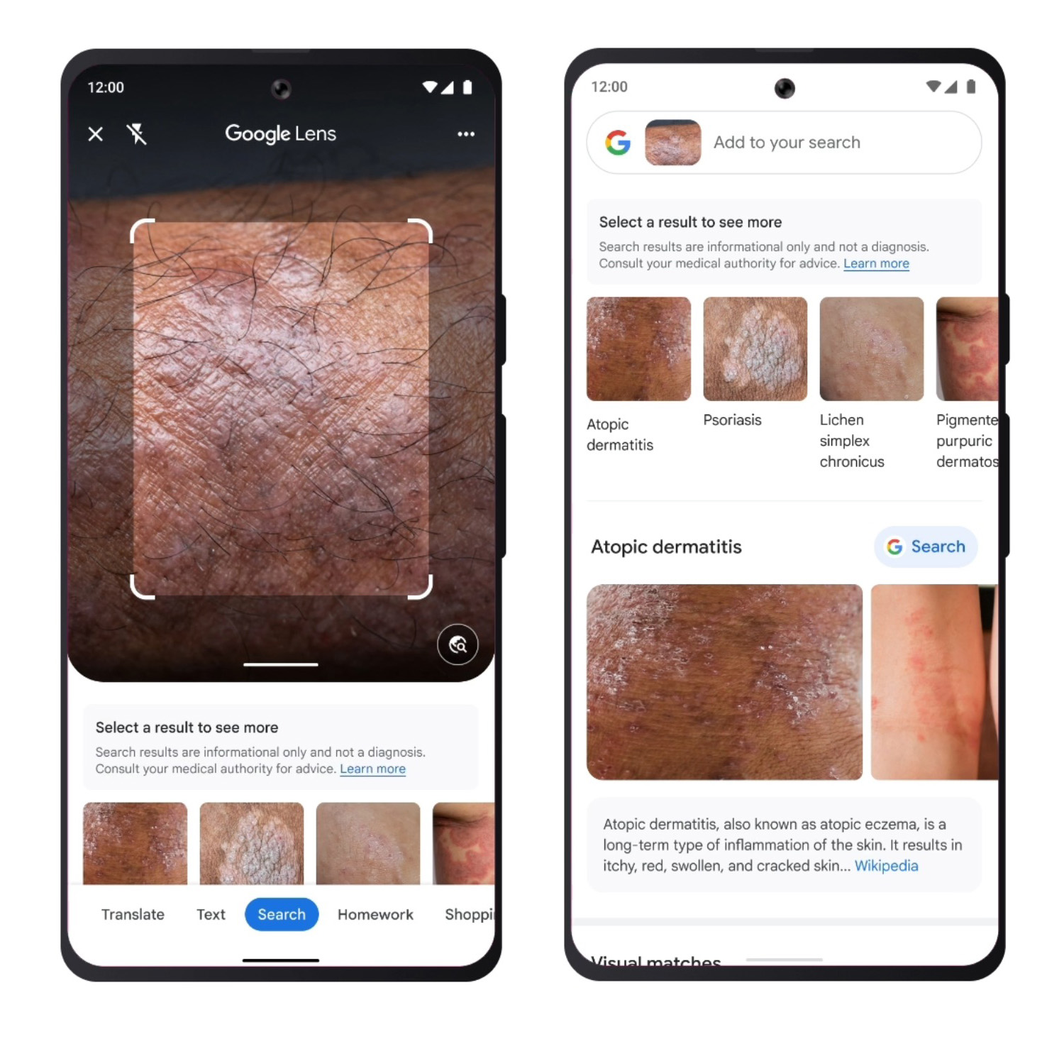 Google Lens Skin Condition